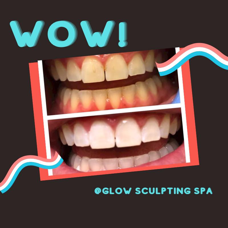 Glow Sculpting Spa Davinci Laser Teeth Whitening