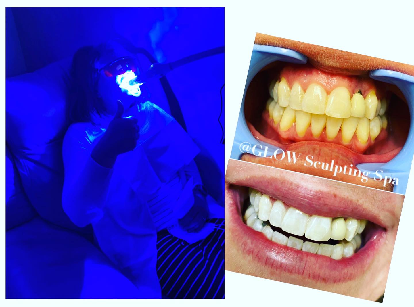 Glow Sculpting Spa Davinci Laser Teeth Whitening